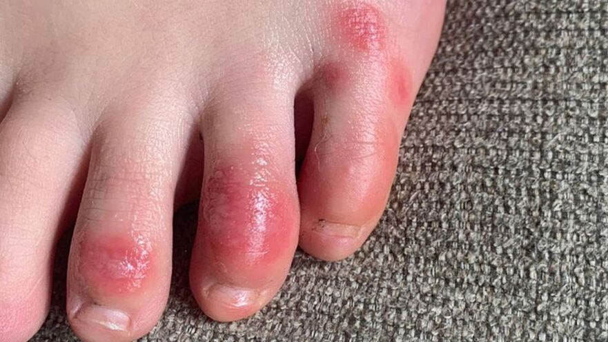 Daño a los pies con un hongo