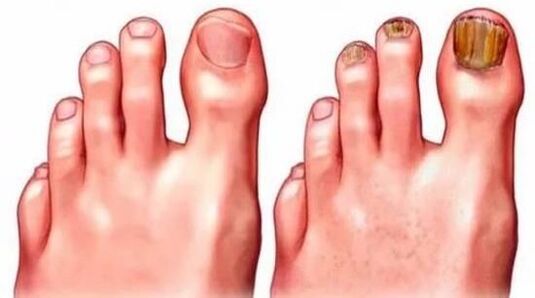 uñas sanas y con hongos