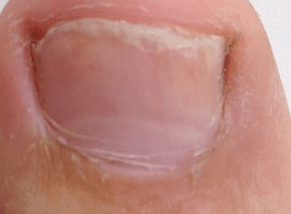 Foto de las etapas iniciales de los hongos en las uñas de los pies.