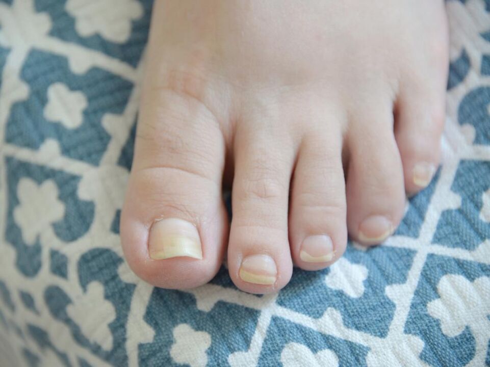 Hongos en las uñas de los pies