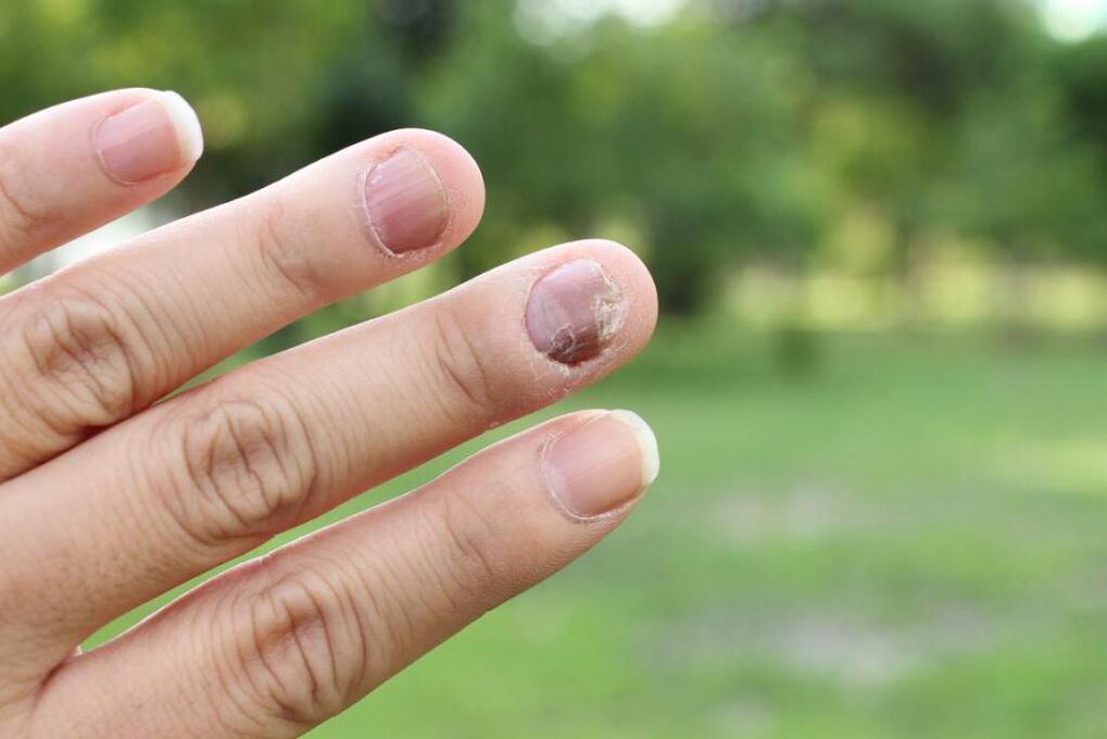 Hongos en las uñas