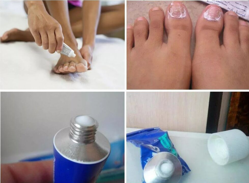 Medicamentos para los hongos en las uñas de los pies.