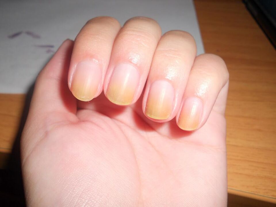 Síntomas de hongos en las uñas.