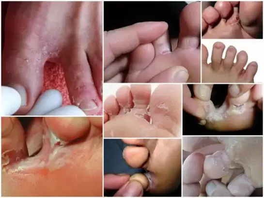 Síntomas de un hongo entre los dedos de los pies Foto 1